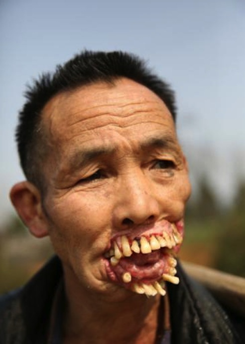 (18+) Kinh hoàng người đàn ông răng mọc ra ngoài