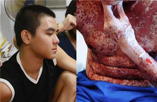 Làn da của Chen De En trước và sau khi mắc bệnh