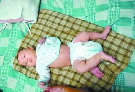 Cô bé Jia Qian chào đời với "chiếc đuôi" ngày một phát triển thành chiếc chân thứ ba
