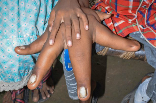 Cậu bé có bàn tay khổng lồ