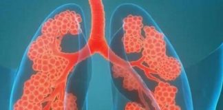 Nghiên cứu: COVID-19 có thể gây tổn thương phổi lâu dài Họ lưu ý rằng chụp MRI xenon siêu cực đại (XeMRI) đã phát hiện thấy những bất thường trong phổi của một số bệnh nhân COVID-19 hơn ba tháng sau khi xuất viện. Ảnh: Twitter / @ HospitalsApollo