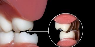 Tại sao chúng ta nghiến răng?!
